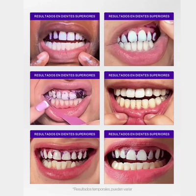 Tiras de Blanqueamiento Avanzado V34 – 14 Aplicaciones