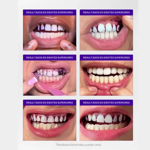 Tiras de Blanqueamiento Avanzado V34 – 14 Aplicaciones